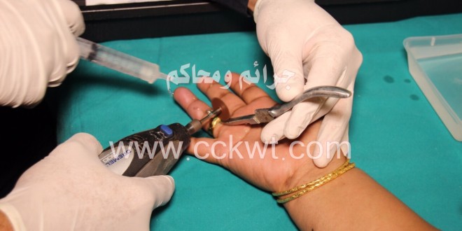 مستشفى مبارك يستعين برجال الإطفاء لتخليص خاتم حُشر بإصبع سيدة